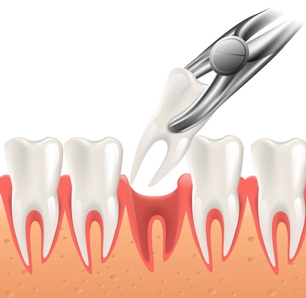 Illustration of a tooth extraction from Oak Park Dental in Salem, OR Illustration of a tooth extraction from Oak Park Dental in Salem, OR
