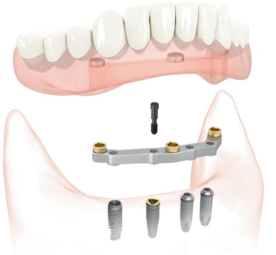 Implant Supported Dentures diagram used by Oak Park Dental in Salem, OR